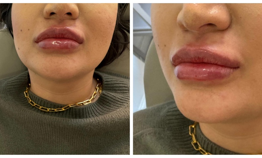 Image 3: 1ml or 2ml Dermal Filler Treatment on Lips with Consultation