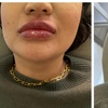 Image 3: 1ml or 2ml Dermal Filler Treatment on Lips with Consultation