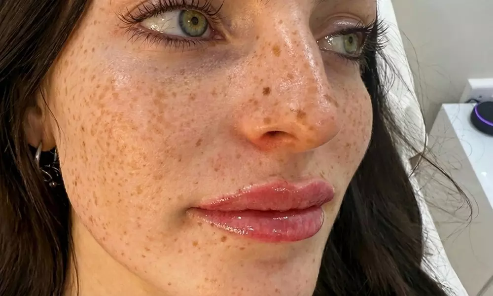 EPTQ Lip Filler 0.5ml or 1.1ml for Fuller, Defined Lips