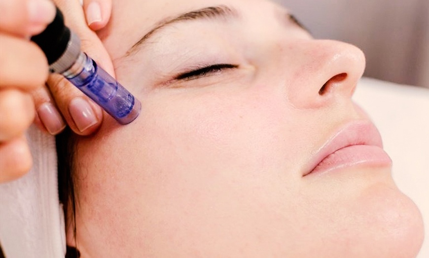 Image 10: 1, 2 o 3 sesiones de microlifting facial de vitaminas con Dermapen