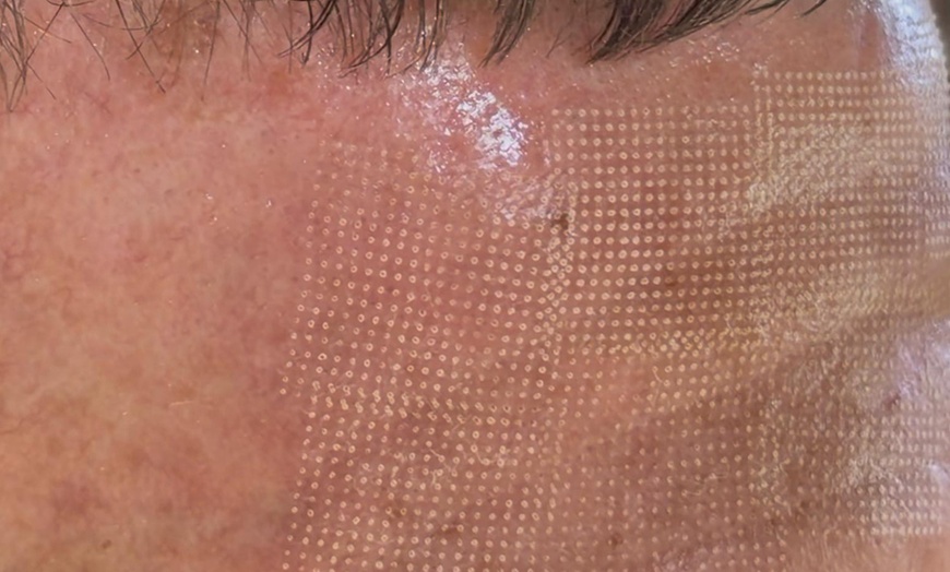 Image 4: 1 o 3 sesiones de rejuvenecimiento facial con láser ‎revitalizante