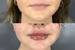Up to 50% Off on Injection - Dermal Filler at River Oaks Galleria Medspa - Second Medium