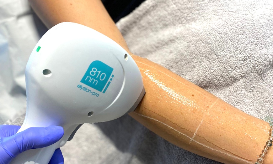 Image 4: Get Smooth Skin: Laser Hair Removal 