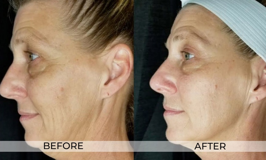 Image 2: Up to 73% Off on Facelift - Non-Surgical at California Trim Clinic Medical Weight Loss