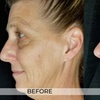 Image 2: Up to 73% Off on Facelift - Non-Surgical at California Trim Clinic Medical Weight Loss
