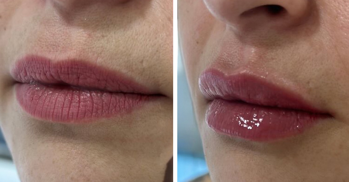 Sesión de hidratación de labios con vitaminas en Madrid