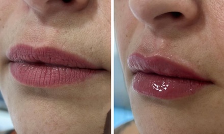 1 sesión de hidratación de labios con relleno dérmico no reticulado - Dr Victor Andres Mejia