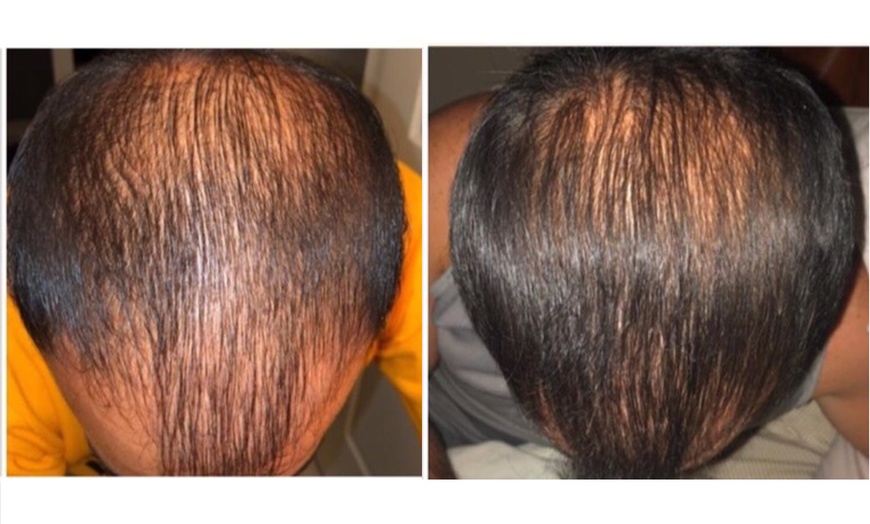 Image 3: Bioestimulación en cuero cabelludo para la regeneración capilar