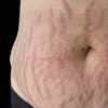 Image 1: Advanced PMU: Improve Scars & Stretch Marks for Smoother Skin