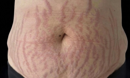 Cosmetic PMU Stretch Mark - Stretch Mark Treatment by Nina