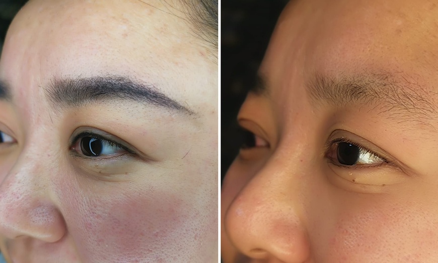 Image 2: 45 Min. Carbon Laser Peeling oder IPL Behandlung nach Wahl für 1 Pers.