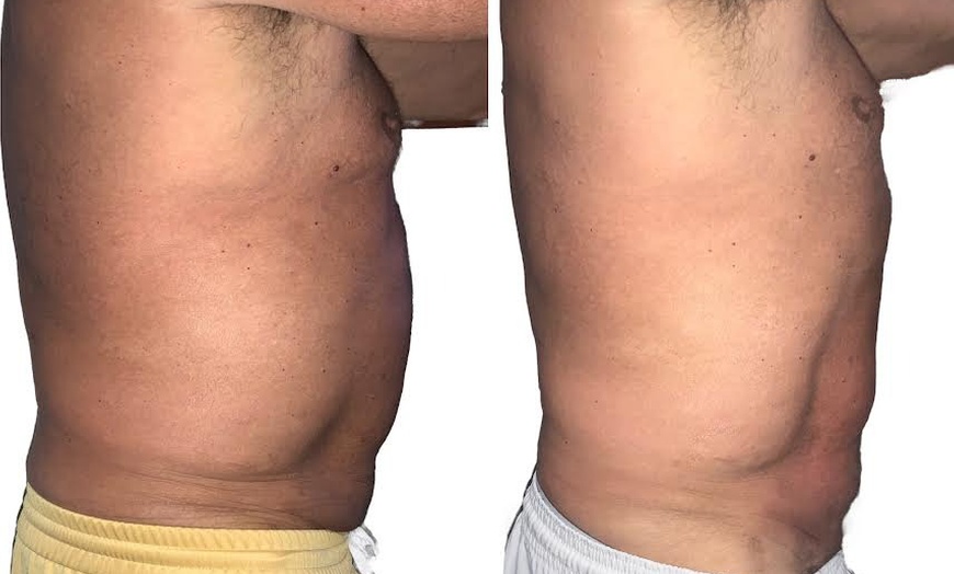 Image 4: Transform Your Body with T-Shape 2 Body Contouring Intro Session
