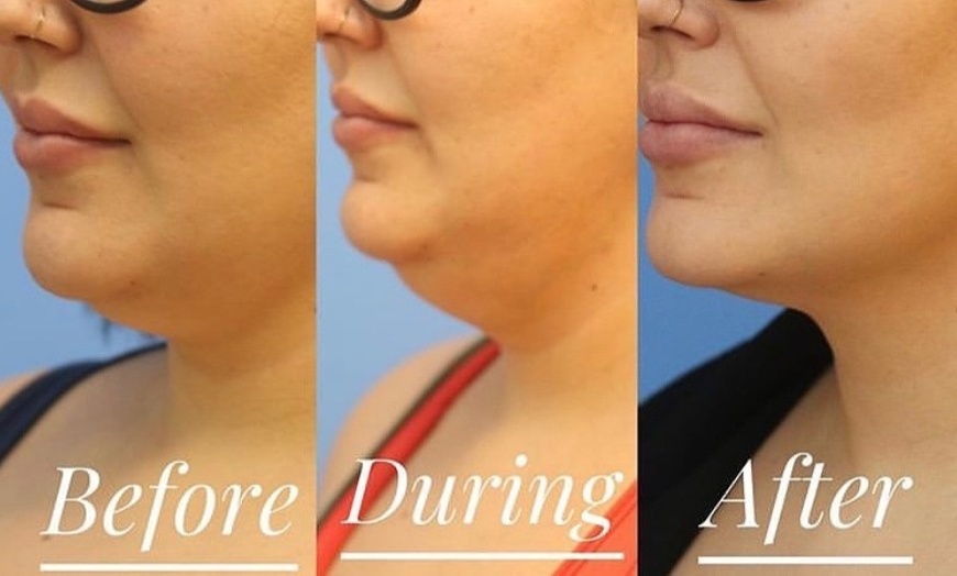 Image 3: 61% Off Kybella Injections at Skin Glow Wellness