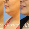 Image 3: 61% Off Kybella Injections at Skin Glow Wellness
