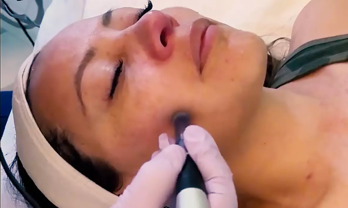 Microneedling with Hyaluronic or Growth Factors, Singles or 3-Packs at Skintastic Spa Boutique - Up to 61% Off - Primary Image
