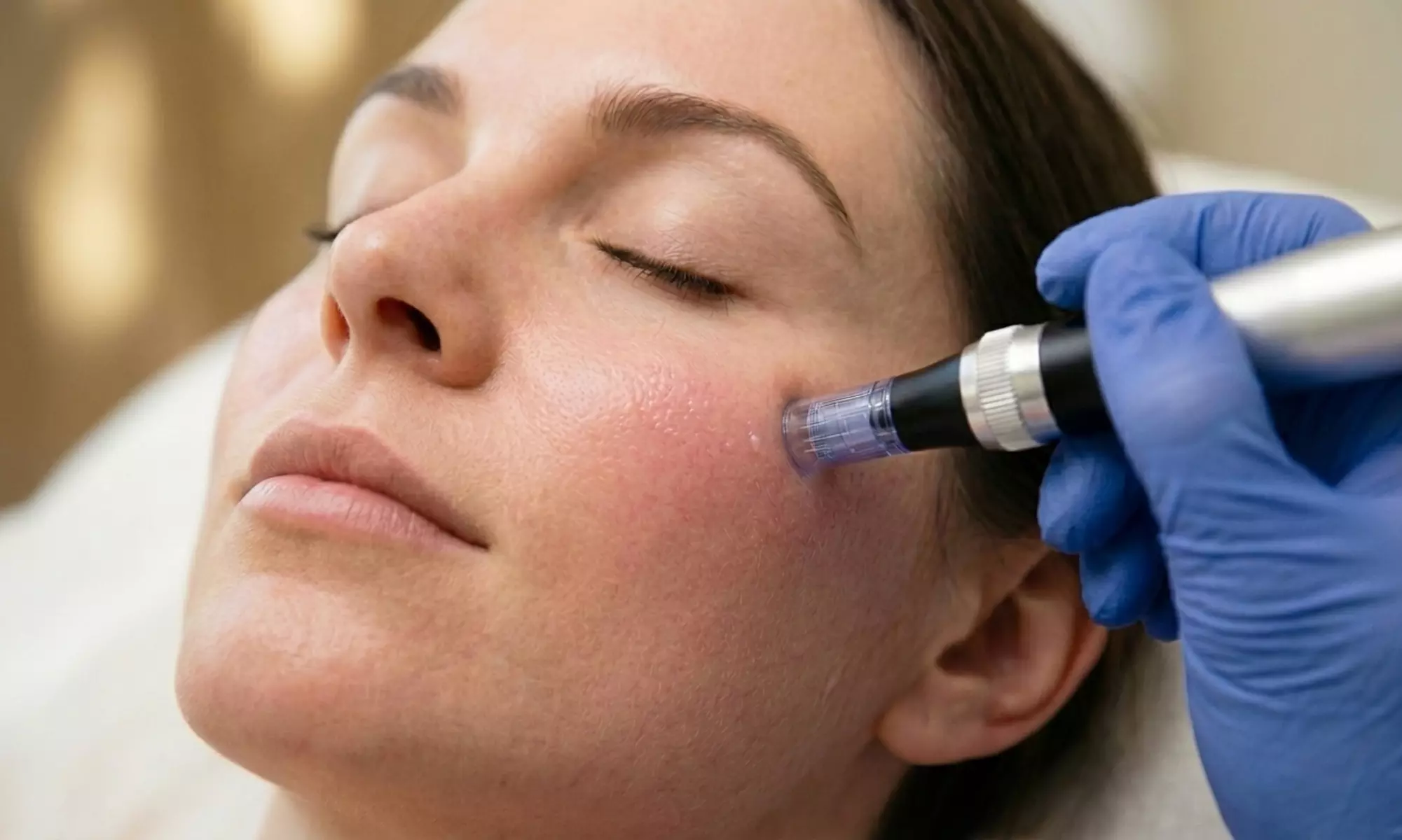Skin Exfoliation and Microneedling Treatments