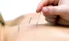 $49.99 for Acupuncture Session for Low Back Pain with Exam at OptiHealth Medical Clinic ($725 Value)