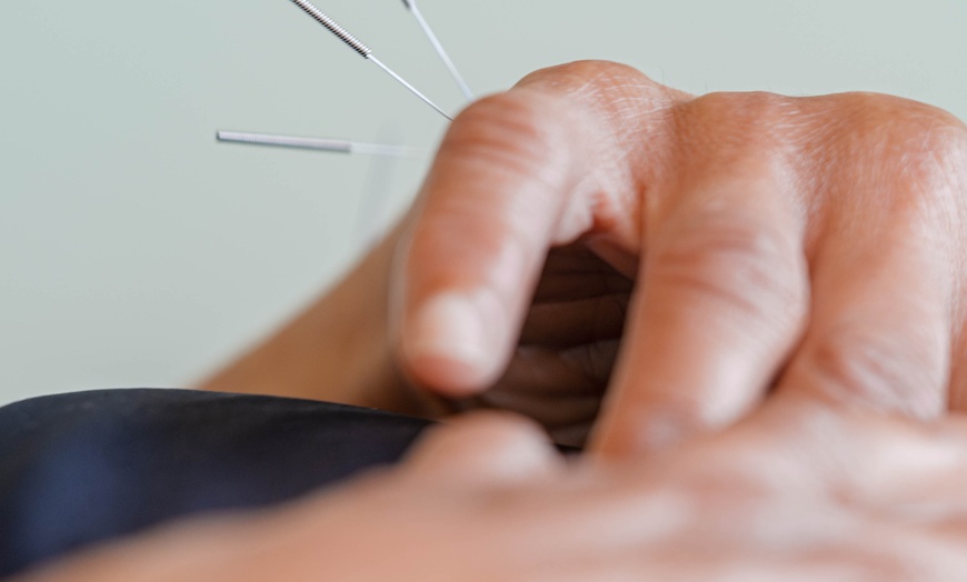 Image 3: Cupping with Deep Tissue Massage or Acupuncture in Shoreditch, London