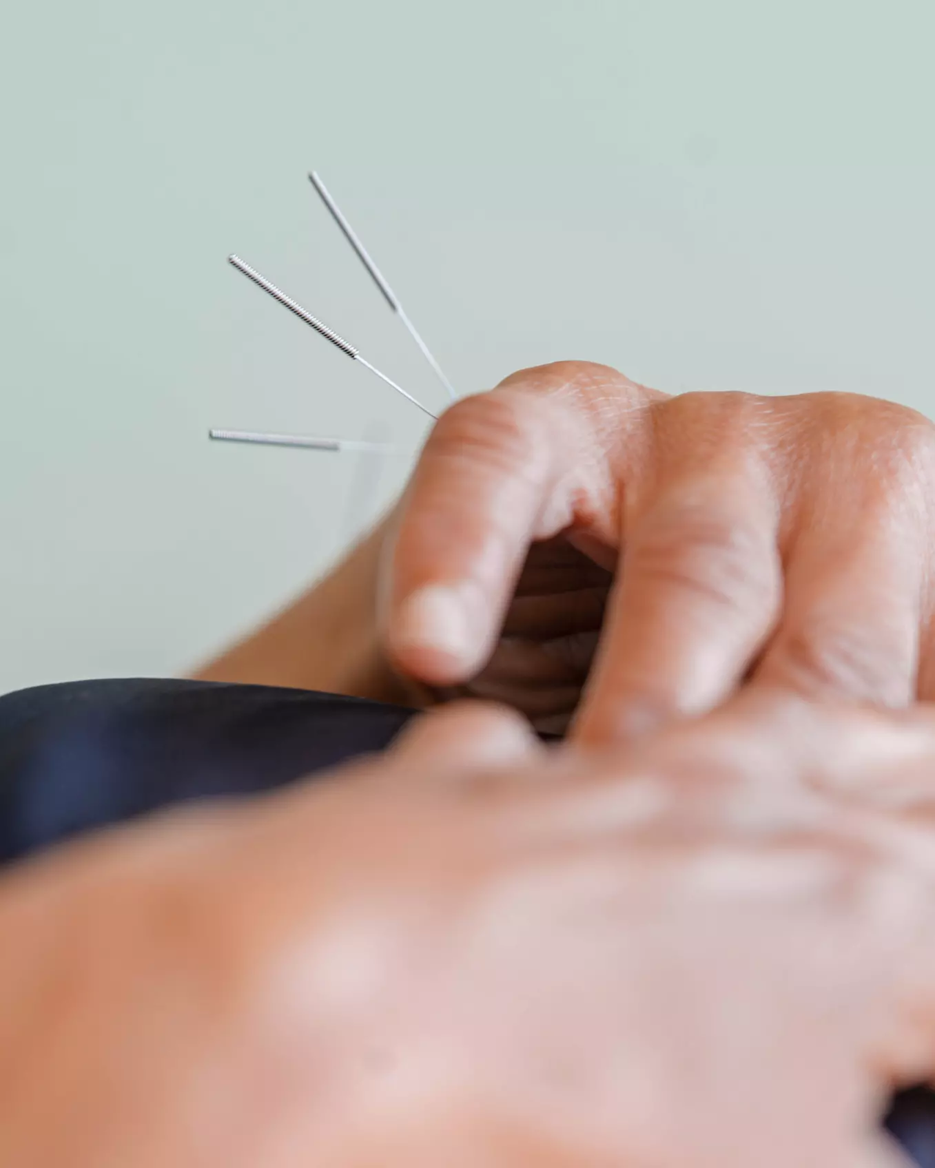 Cupping with Deep Tissue Massage or Acupuncture in Shoreditch, London