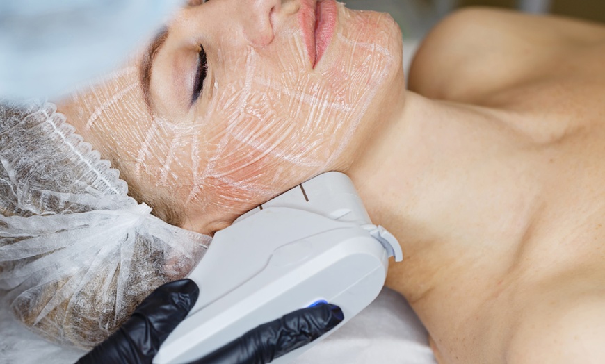 Image 1: Up to 30% Off on IPL Photo Facial at Prolase Medispa