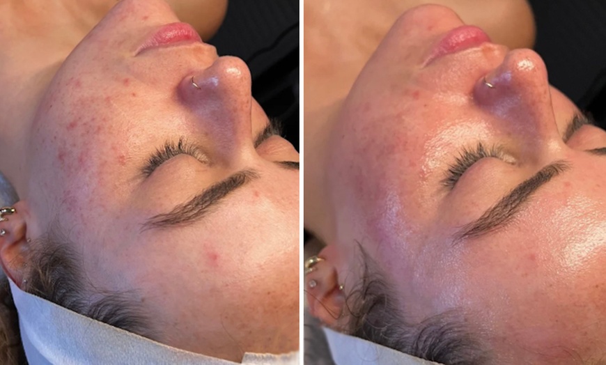 Image 2: Reveal Glowing Skin with One or Two VI Peel