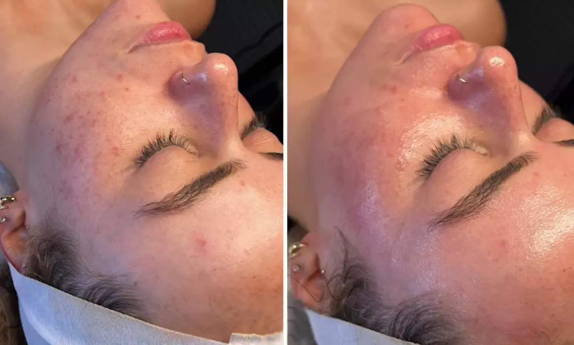 Reveal Glowing Skin with One or Two VI Peel