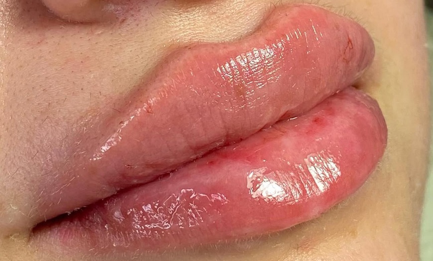 Image 5: Smooth, Plump & Perfect: Versa Enhancements at Divaa Beauty