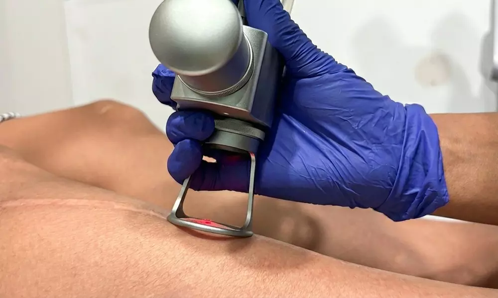Laser Treatment for Scars & Stretch Marks at Cosmedici Laser - Up to 67% Off