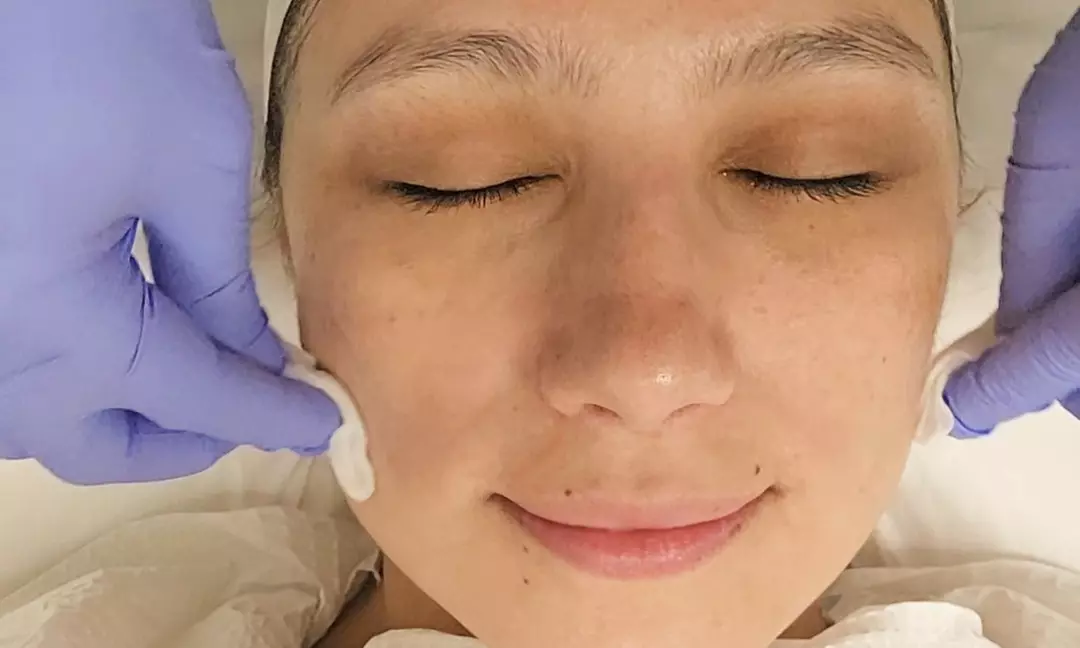 Experience Radiance: One or Three Light or Deep Chemical Peels