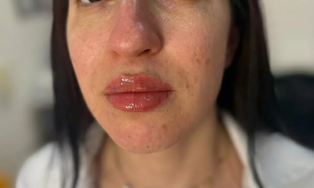 EPTQ Lip Filler 0.5ml or 1.1ml for Fuller, Defined Lips