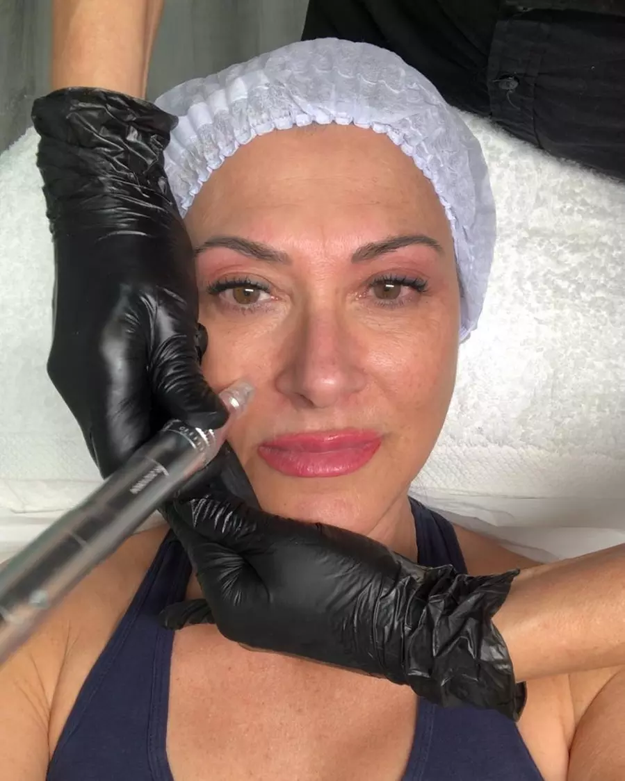 Tratamiento facial Hollywood Peel con mascarilla de carbón activo