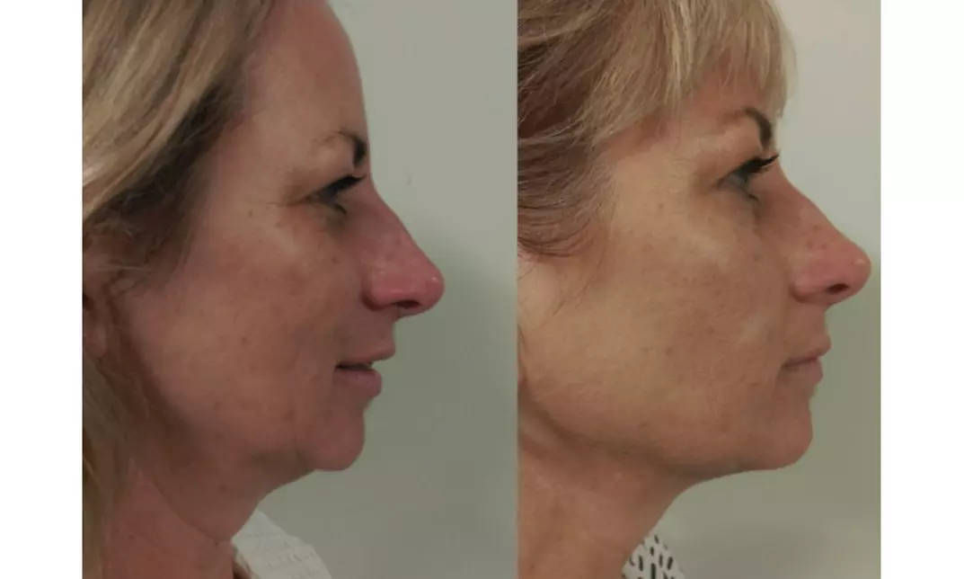 Non-Invasive HIFU Treatments for Crow's Feet, Chin & More