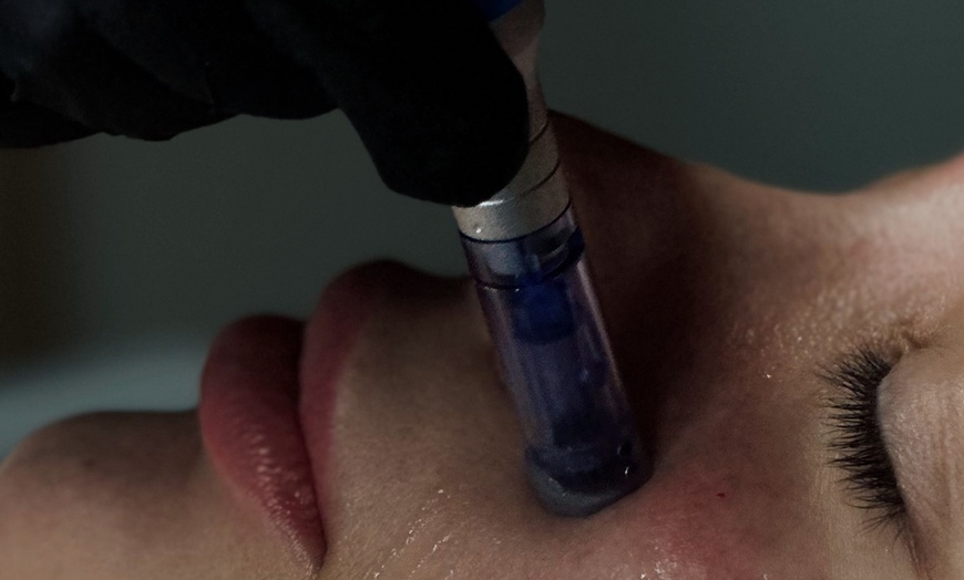 Image 2: One or Three Sessions Micro-needling w/ Glow Skin Booster (PDRN-Based)