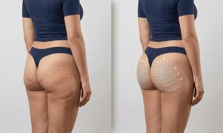 Sculptra Butt Lift Treatment with Two Vials (5cc per Vials) - SlimmThicc Aesthetics