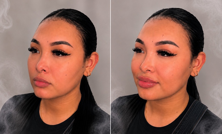 Image 3: Revanesse Versa Dermal Filler: Natural Lip & Facial Enhancement