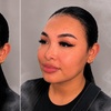 Image 3: Revanesse Versa Dermal Filler: Natural Lip & Facial Enhancement