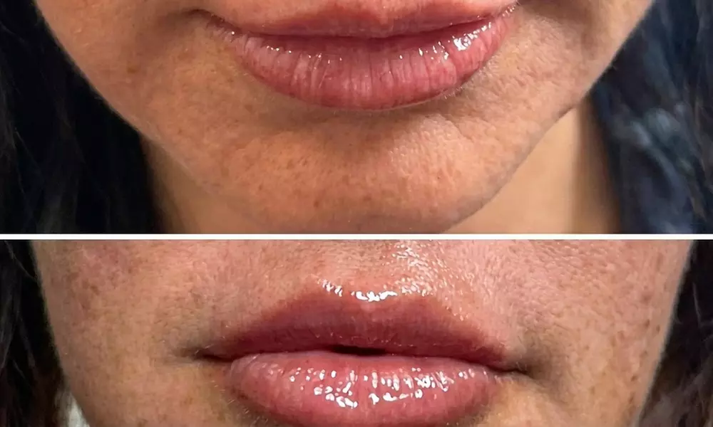Hyaluronic Acid Lip Filler for Enhancement