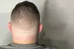 2 or 4 Hour Scalp Micropigmentation for Hairline, Crown or Full Scalp Restoration at Authentic SMP(Up to 33%Off) - Second Medium