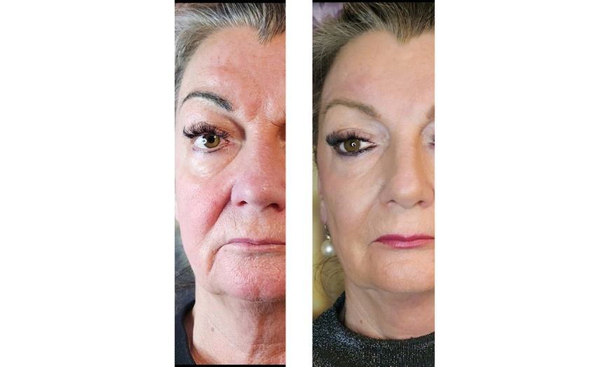 Image 6: Microneedling für Gesicht, opt. inkl. Hals oder SQT BiONeedling
