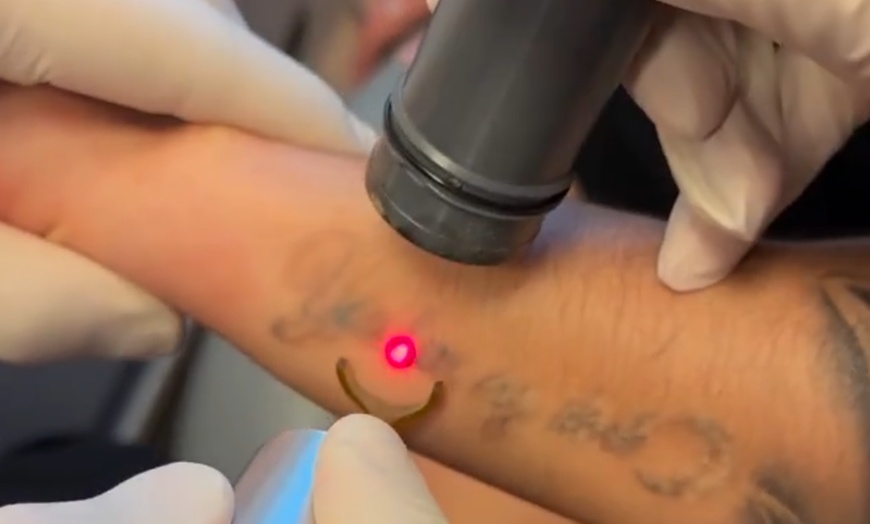 Image 1: Laser Tattoo Removal at Sublime Medical Aesthetics & Dermatology