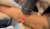 Fade Unwanted Ink with Up to 71% Off  Laser Tattoo Removal at Sublime Medical Aesthetics