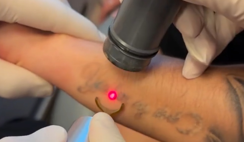 Laser Tattoo Removal at Sublime Medical Aesthetics & Dermatology