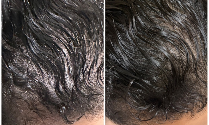 Image 3: Dermclar Method Hair Loss prevention and Neck Massage