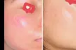Break Up With Breakouts: Pore-Cleansing Acne Facials & Treatments at The Skin Sanctuary - Second Medium