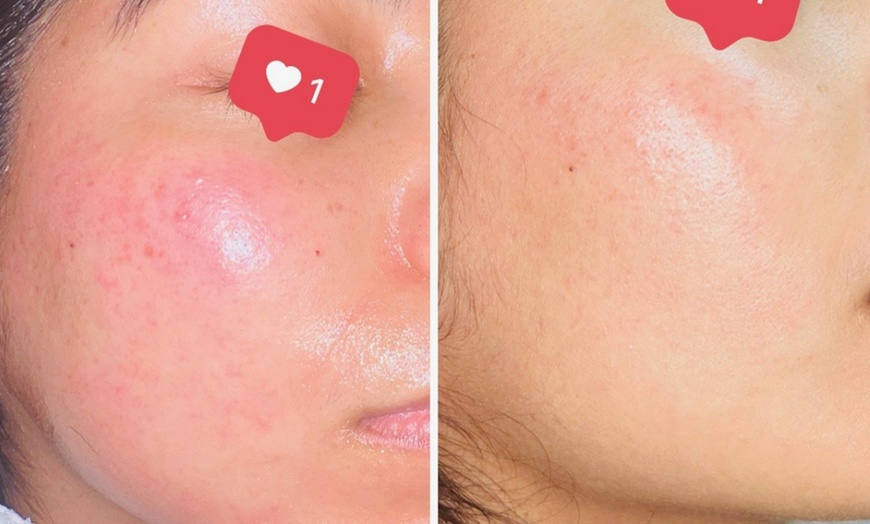 Image 2: Break Up With Breakouts: Pore-Cleansing Acne Facials & Treatments