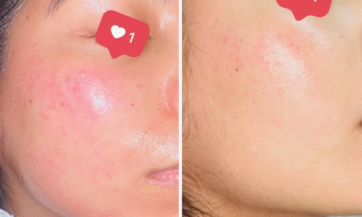 Break Up With Breakouts: Pore-Cleansing Acne Facials & Treatments