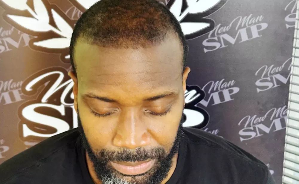 Boost Your Confidence With Scalp Micropigmentation
