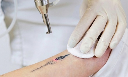 Three Laser Tattoo Removal Sessions on a Small Area (Up to 4 inches) - AZ Laser RX & Med Spa