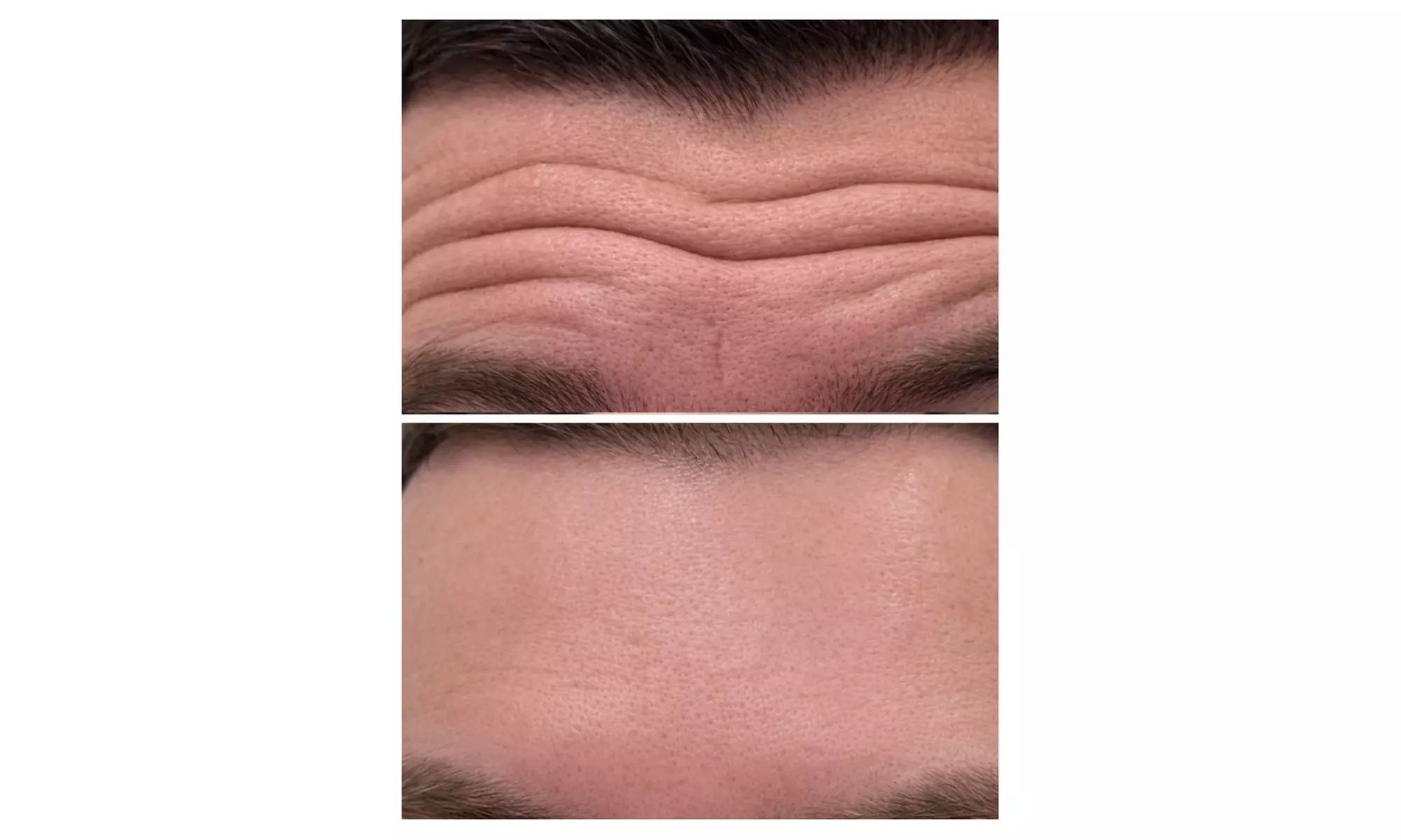 Enhance Your Look with 20, 40, or 60 Units of Botox