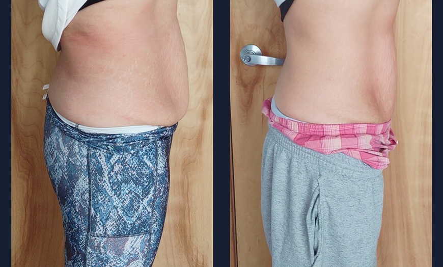 Image 3: Intro Cryo Slimming or 4 or 6 Cryo Contour Sessions